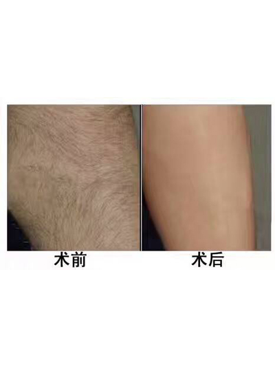 冰點脫毛